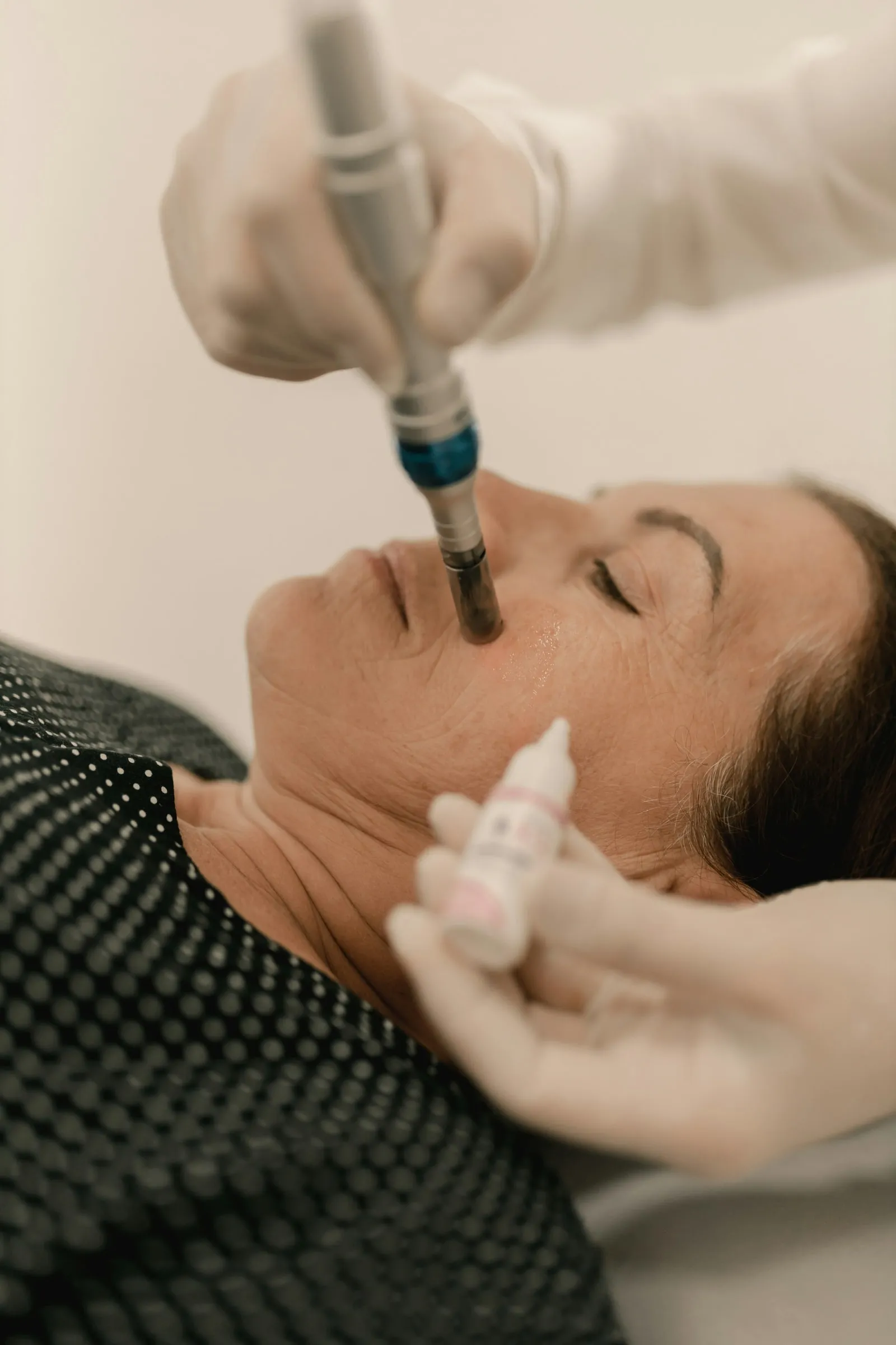 Mesoterapia facial: microinyecciones de vitaminas en el rostro